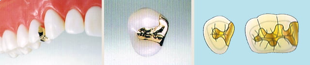 ゴールド - （種類）金属のインレー ・ スタンダードタイプ ／ （主材質）高カラット金合金