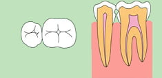歯内療法1