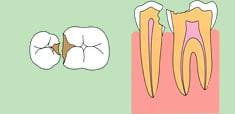 歯内療法2