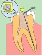 歯内療法3