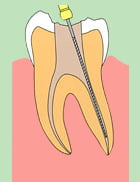 歯内療法4