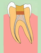 歯内療法5