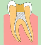 歯内療法6