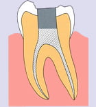 歯内療法7-1