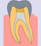 歯内療法7-2