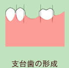 支台歯の形成