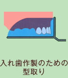 入れ歯作製のための型取り