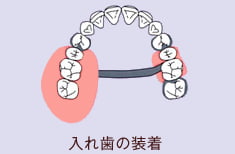 入れ歯の装着